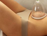 Cupping masaža abdomena za mršavljenje Cupping masaža abdomena kako se pravilno radi